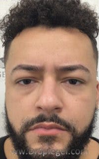 Botox / Dysport / Jeuveau / Xeomin Before & After Gallery - Patient 290673 - Image 2