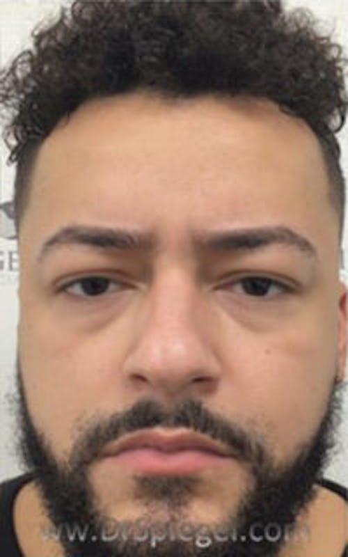 Botox / Dysport / Jeuveau / Xeomin Before & After Gallery - Patient 290673 - Image 2