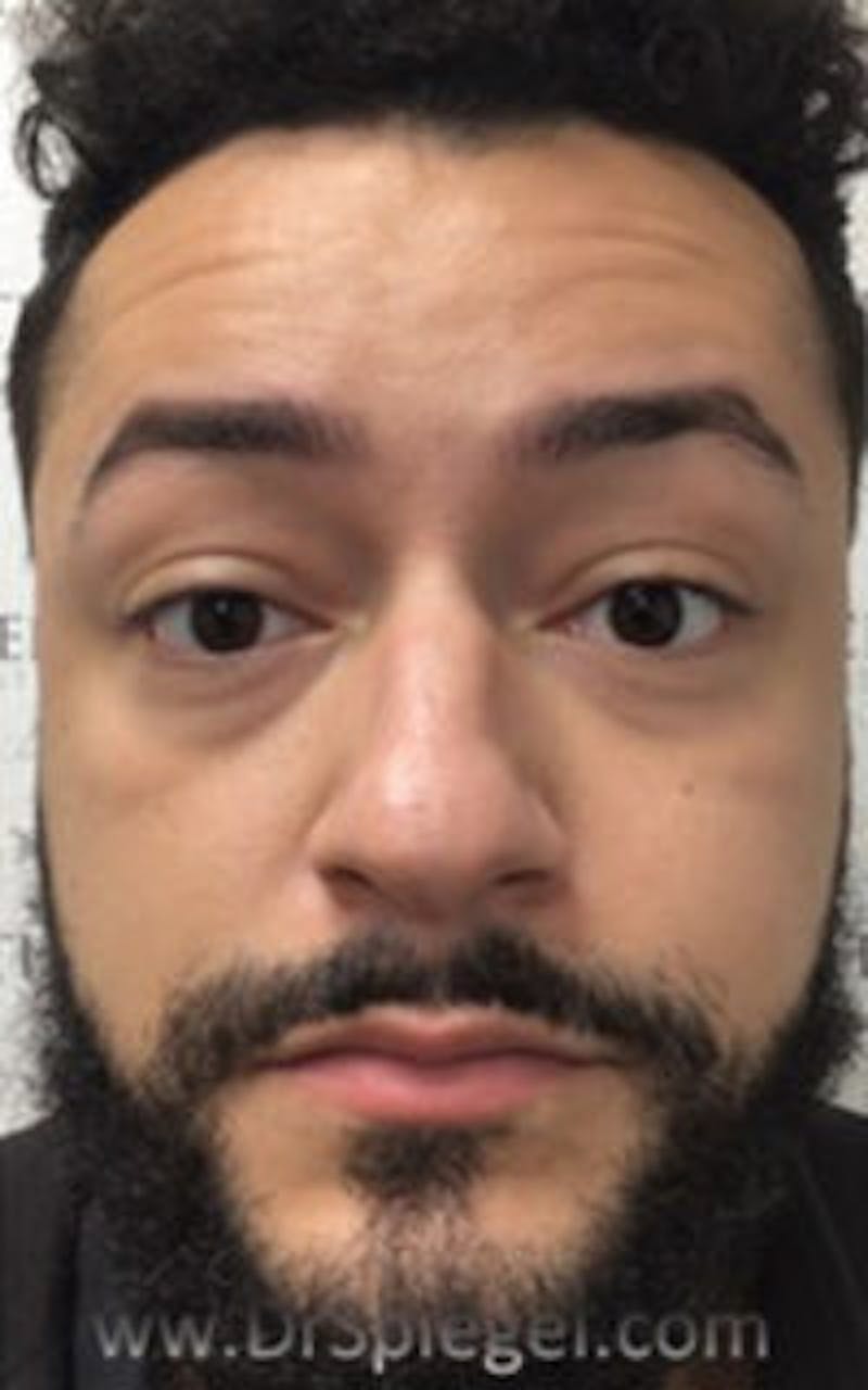 Botox / Dysport / Jeuveau / Xeomin Before & After Gallery - Patient 290673 - Image 3