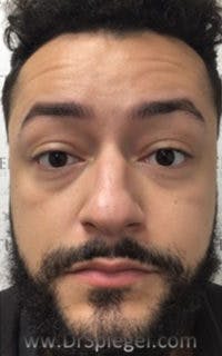 Botox / Dysport / Jeuveau / Xeomin Before & After Gallery - Patient 290673 - Image 3