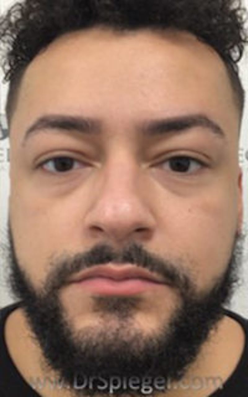 Botox / Dysport / Jeuveau / Xeomin Before & After Gallery - Patient 290673 - Image 4