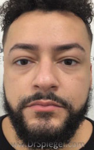 Botox / Dysport / Jeuveau / Xeomin Before & After Gallery - Patient 290673 - Image 4