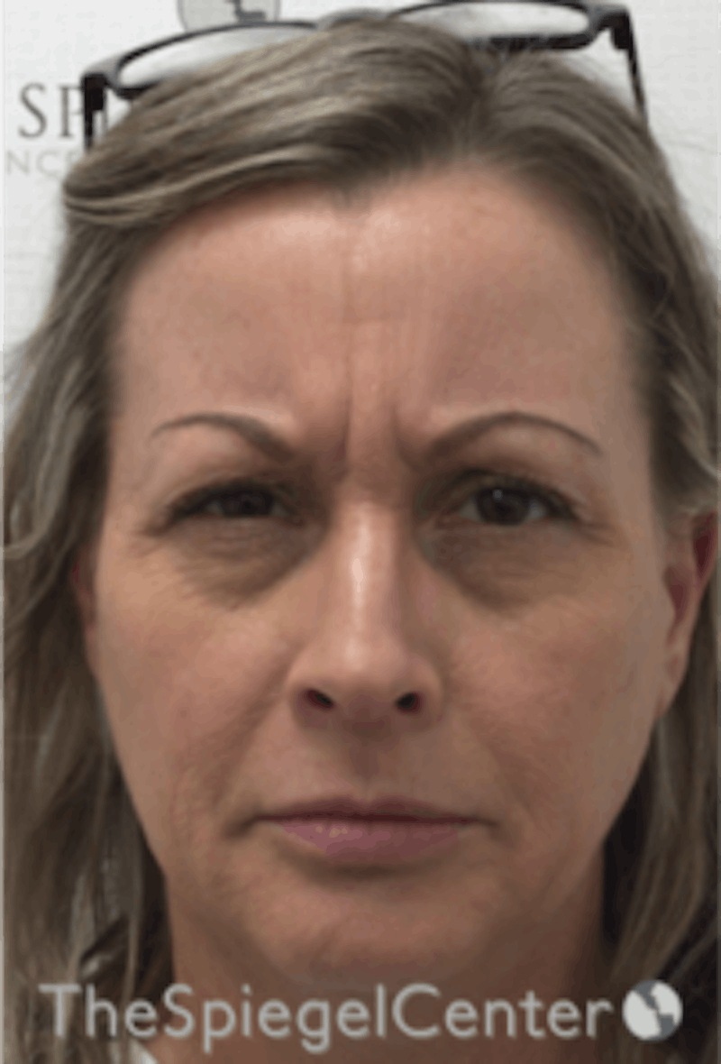 Botox / Dysport / Jeuveau / Xeomin Before & After Gallery - Patient 275332 - Image 1