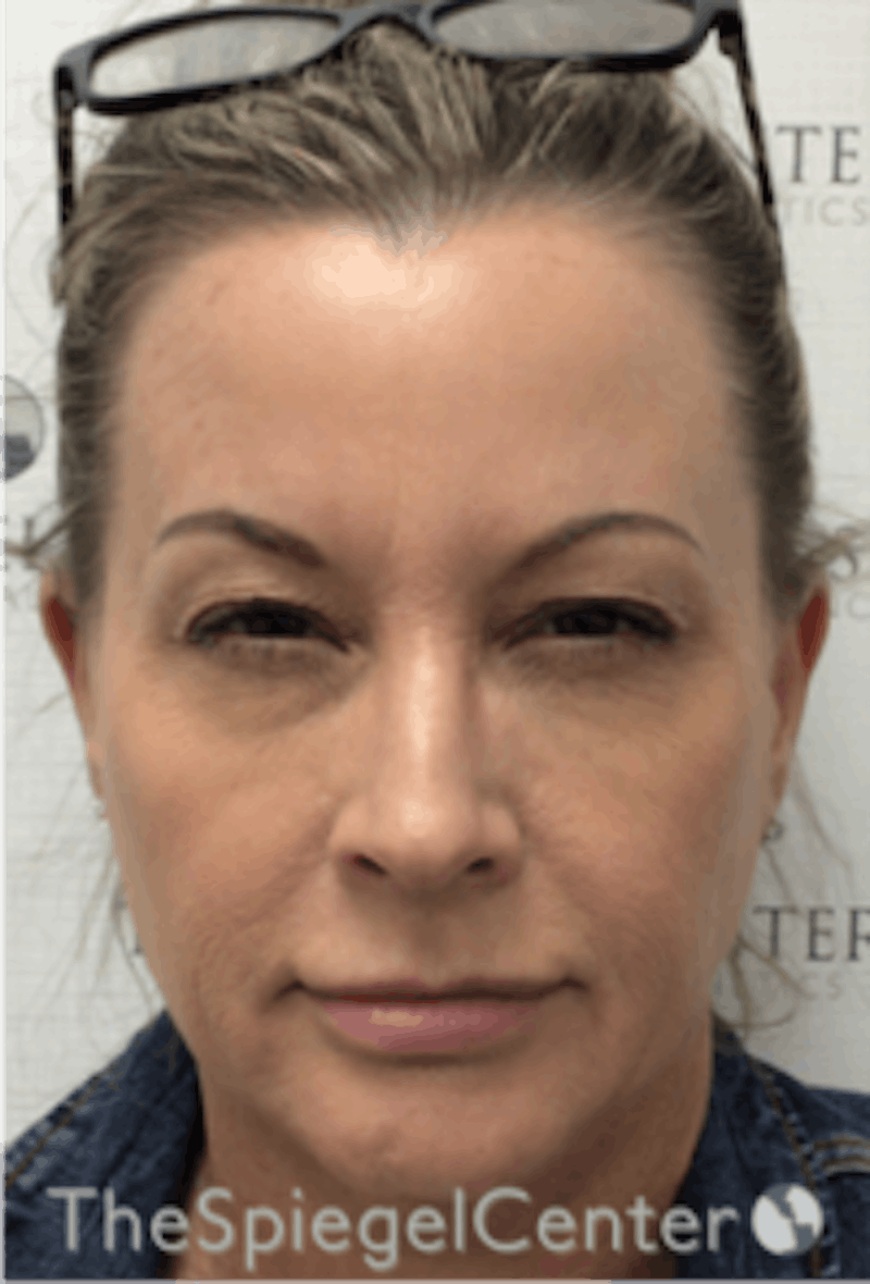 Botox / Dysport / Jeuveau / Xeomin Before & After Gallery - Patient 275332 - Image 2
