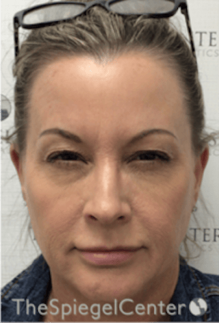 Botox / Dysport / Jeuveau / Xeomin Before & After Gallery - Patient 275332 - Image 2