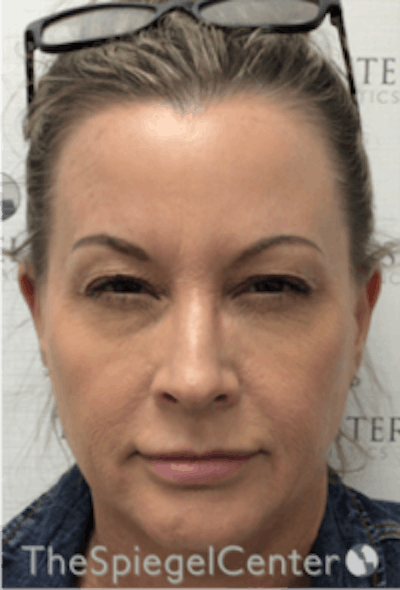 Botox / Dysport / Jeuveau / Xeomin Before & After Gallery - Patient 275332 - Image 2