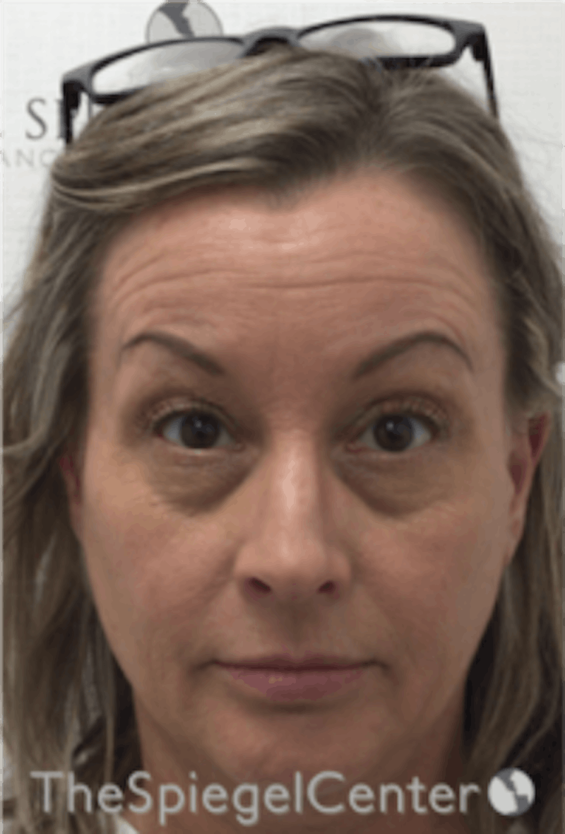 Botox / Dysport / Jeuveau / Xeomin Before & After Gallery - Patient 275332 - Image 3
