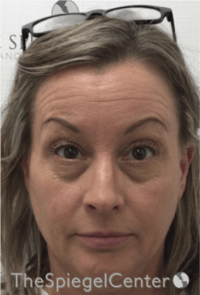 Botox / Dysport / Jeuveau / Xeomin Before & After Gallery - Patient 275332 - Image 3