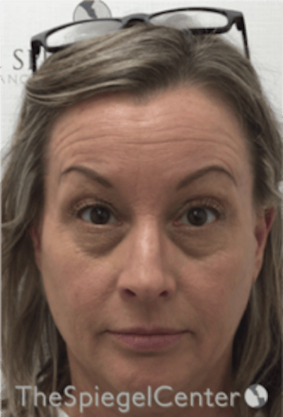 Botox / Dysport / Jeuveau / Xeomin Before & After Gallery - Patient 275332 - Image 3