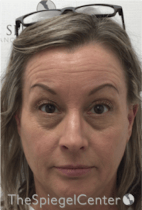 Botox / Dysport / Jeuveau / Xeomin Before & After Gallery - Patient 275332 - Image 3