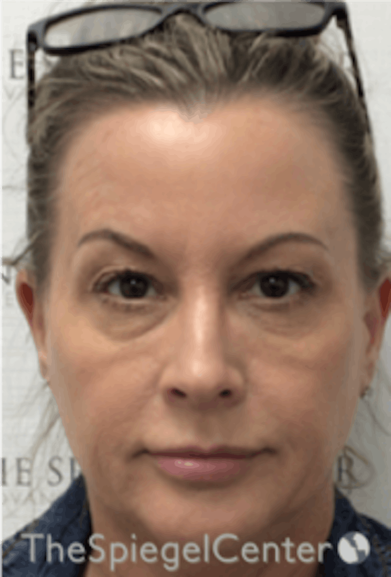 Botox / Dysport / Jeuveau / Xeomin Before & After Gallery - Patient 275332 - Image 4