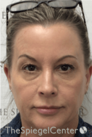 Botox / Dysport / Jeuveau / Xeomin Before & After Gallery - Patient 275332 - Image 4