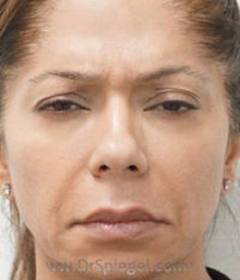 Botox / Dysport / Jeuveau / Xeomin Before & After Gallery - Patient 184327 - Image 1