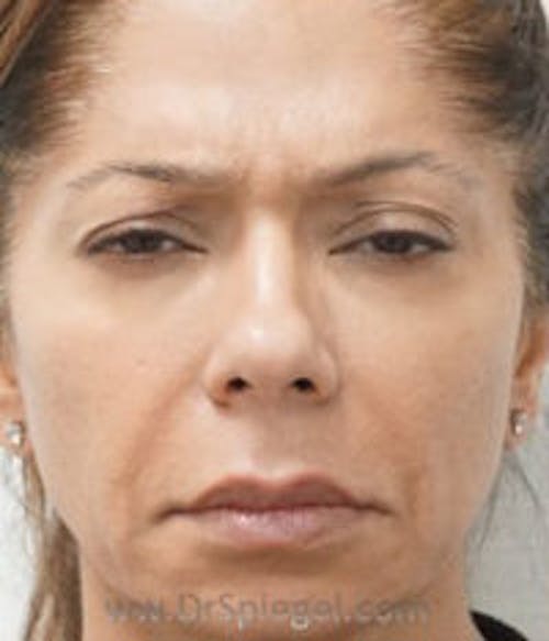 Botox / Dysport / Jeuveau / Xeomin Before & After Gallery - Patient 184327 - Image 1