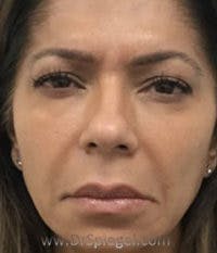Botox / Dysport / Jeuveau / Xeomin Before & After Gallery - Patient 184327 - Image 2