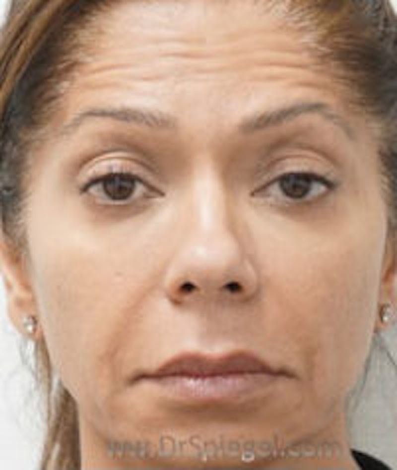 Botox / Dysport / Jeuveau / Xeomin Before & After Gallery - Patient 184327 - Image 3