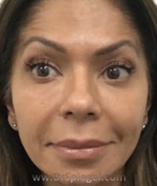 Botox / Dysport / Jeuveau / Xeomin Before & After Gallery - Patient 184327 - Image 4