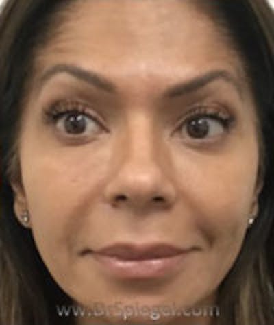 Botox / Dysport / Jeuveau / Xeomin Before & After Gallery - Patient 184327 - Image 4