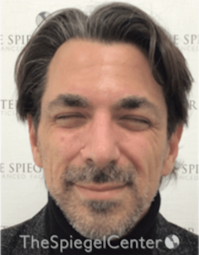 Botox / Dysport / Jeuveau / Xeomin Before & After Gallery - Patient 980520 - Image 1