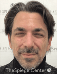 Botox / Dysport / Jeuveau / Xeomin Before & After Gallery - Patient 980520 - Image 1