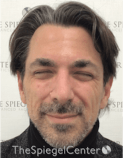 Botox / Dysport / Jeuveau / Xeomin Before & After Gallery - Patient 980520 - Image 1