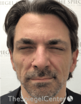 Botox / Dysport / Jeuveau / Xeomin Before & After Gallery - Patient 980520 - Image 2