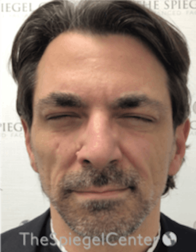 Botox / Dysport / Jeuveau / Xeomin Before & After Gallery - Patient 980520 - Image 2