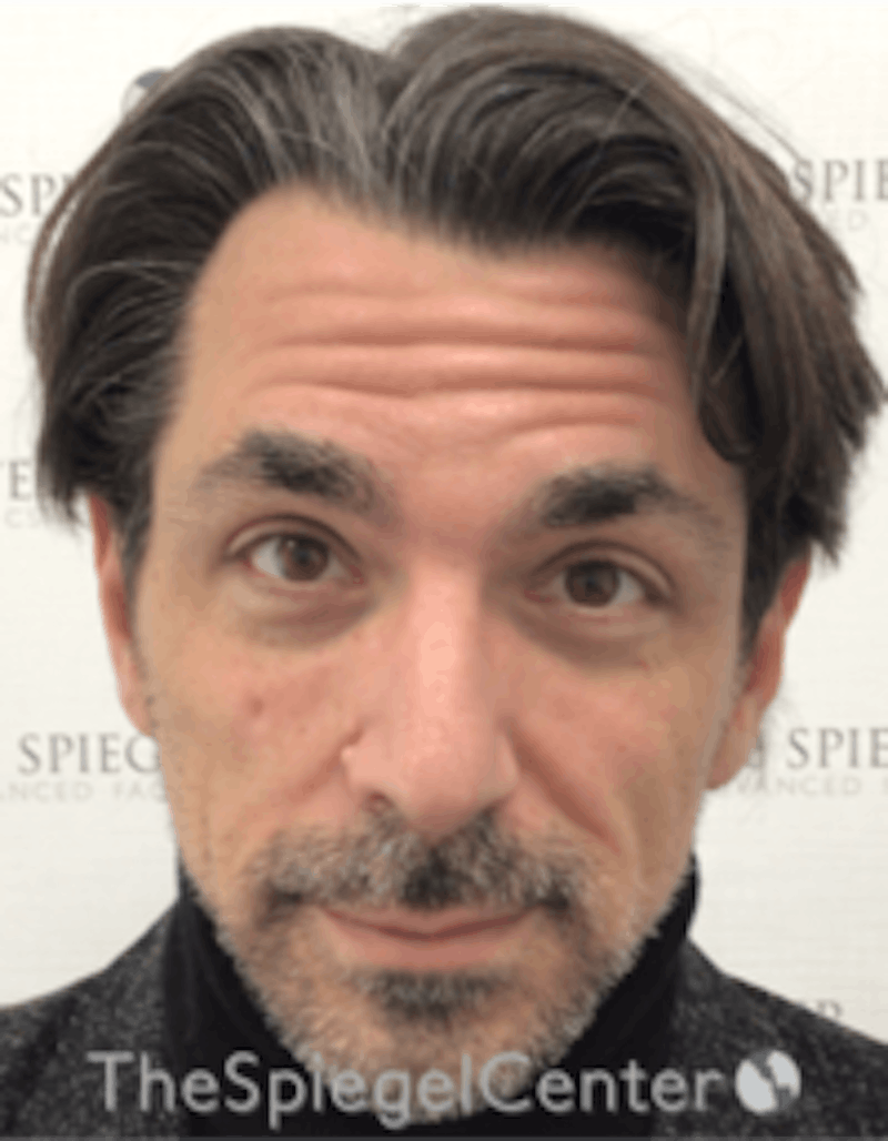 Botox / Dysport / Jeuveau / Xeomin Before & After Gallery - Patient 980520 - Image 3