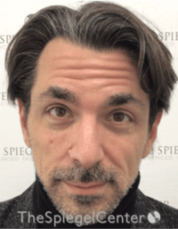 Botox / Dysport / Jeuveau / Xeomin Before & After Gallery - Patient 980520 - Image 3