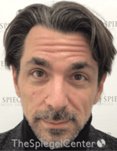 Botox / Dysport / Jeuveau / Xeomin Before & After Gallery - Patient 980520 - Image 3