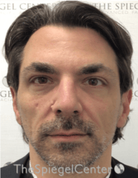 Botox / Dysport / Jeuveau / Xeomin Before & After Gallery - Patient 980520 - Image 4