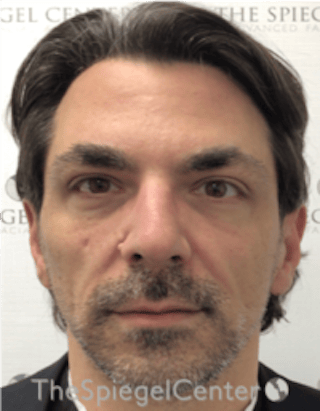 Botox / Dysport / Jeuveau / Xeomin Before & After Gallery - Patient 980520 - Image 4