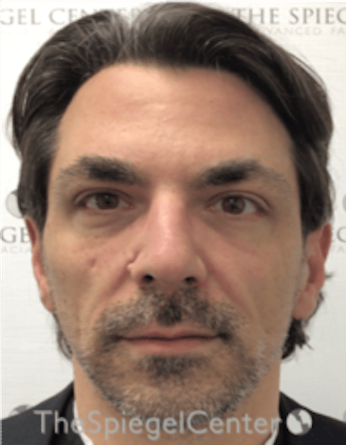 Botox / Dysport / Jeuveau / Xeomin Before & After Gallery - Patient 980520 - Image 4