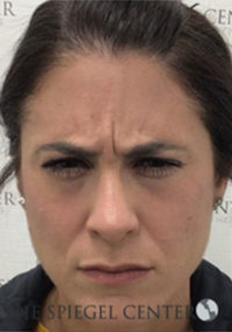 Botox / Dysport / Jeuveau / Xeomin Before & After Gallery - Patient 403136 - Image 1