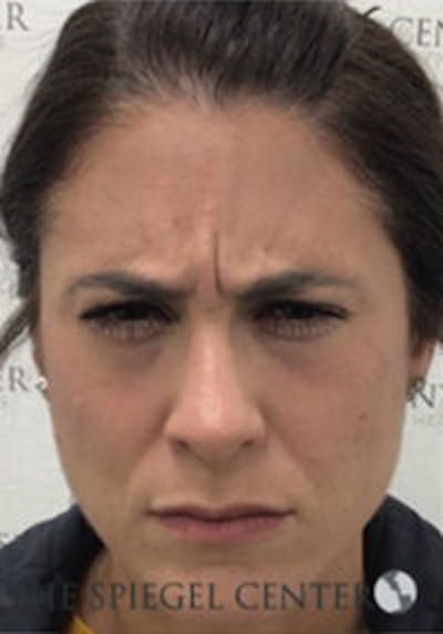 Botox / Dysport / Jeuveau / Xeomin Before & After Gallery - Patient 403136 - Image 1