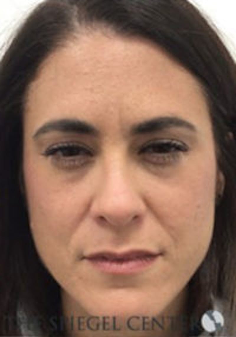 Botox / Dysport / Jeuveau / Xeomin Before & After Gallery - Patient 403136 - Image 2