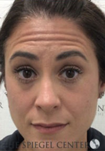 Botox / Dysport / Jeuveau / Xeomin Before & After Gallery - Patient 403136 - Image 3