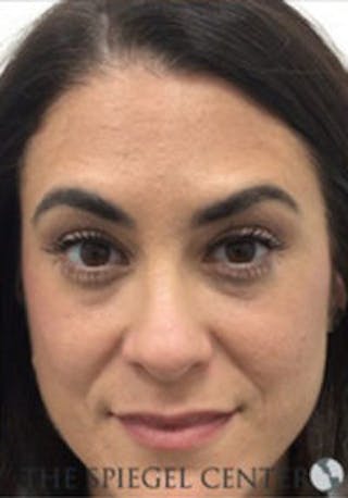 Botox / Dysport / Jeuveau / Xeomin Before & After Gallery - Patient 403136 - Image 4