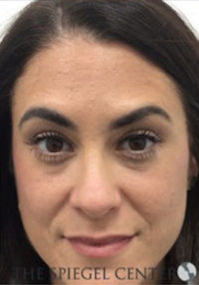 Botox / Dysport / Jeuveau / Xeomin Before & After Gallery - Patient 403136 - Image 4