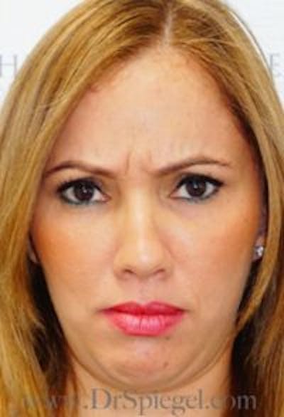 Botox / Dysport / Jeuveau / Xeomin Before & After Gallery - Patient 181016 - Image 1