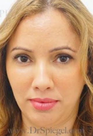 Botox / Dysport / Jeuveau / Xeomin Before & After Gallery - Patient 181016 - Image 2