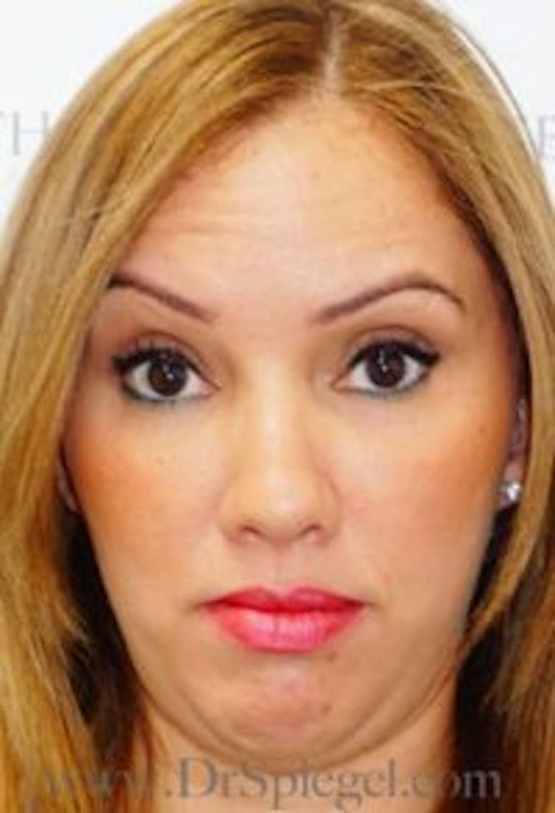 Botox / Dysport / Jeuveau / Xeomin Before & After Gallery - Patient 181016 - Image 3