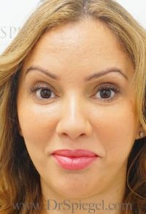 Botox / Dysport / Jeuveau / Xeomin Before & After Gallery - Patient 181016 - Image 4