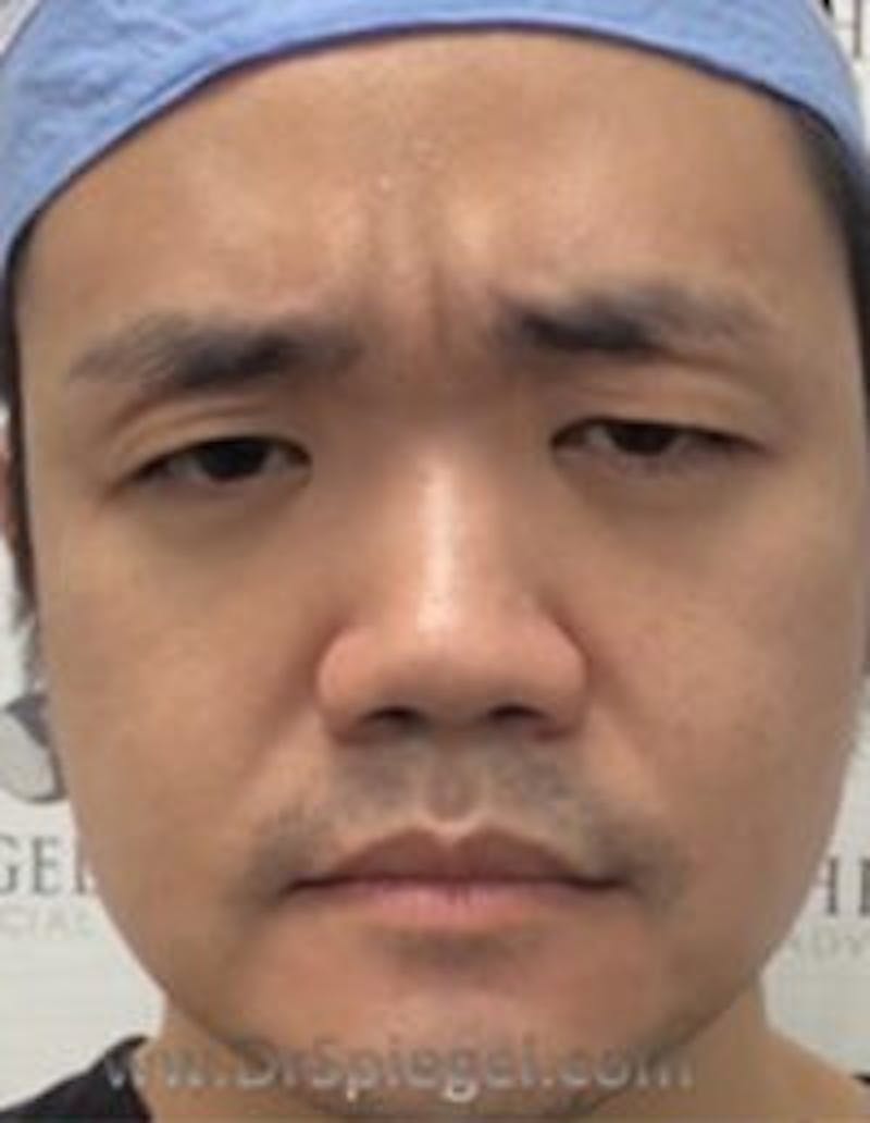 Botox / Dysport / Jeuveau / Xeomin Before & After Gallery - Patient 309521 - Image 1