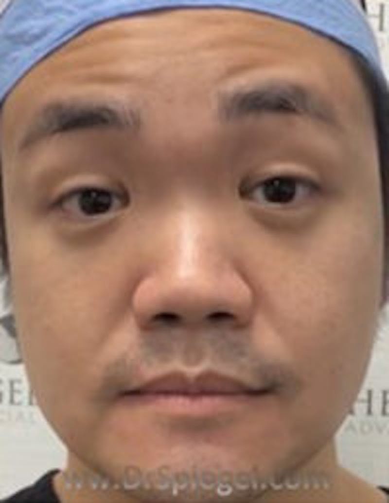 Botox / Dysport / Jeuveau / Xeomin Before & After Gallery - Patient 309521 - Image 3