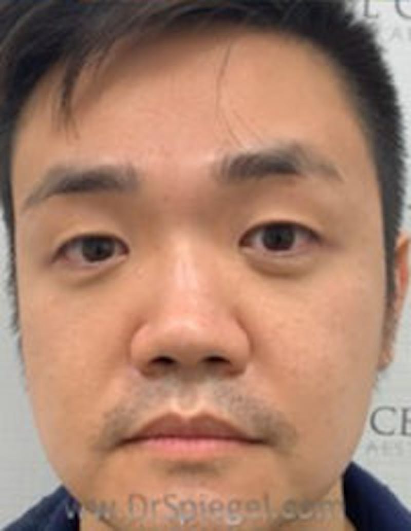 Botox / Dysport / Jeuveau / Xeomin Before & After Gallery - Patient 309521 - Image 4