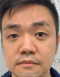 Botox / Dysport / Jeuveau / Xeomin Before & After Gallery - Patient 309521 - Image 4