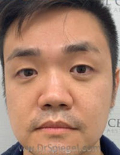 Botox / Dysport / Jeuveau / Xeomin Before & After Gallery - Patient 309521 - Image 4