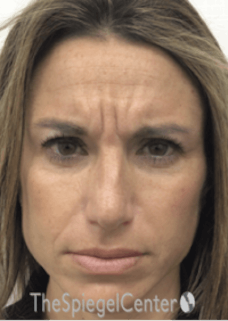 Botox / Dysport / Jeuveau / Xeomin Before & After Gallery - Patient 489094 - Image 1