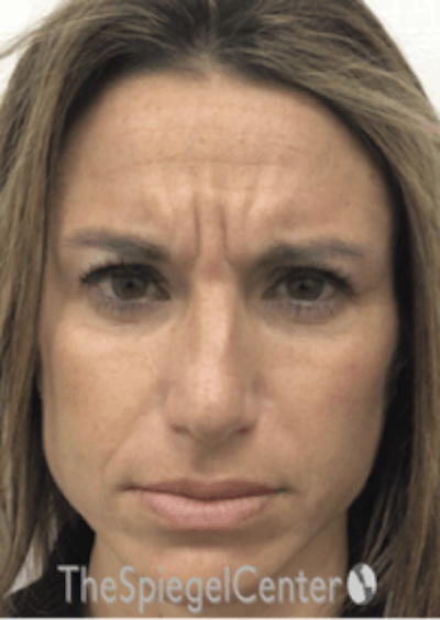 Botox / Dysport / Jeuveau / Xeomin Before & After Gallery - Patient 489094 - Image 1